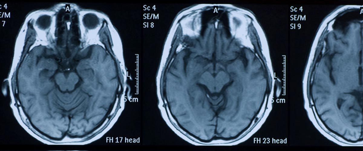 Traumatic brain injuries/ Concussions